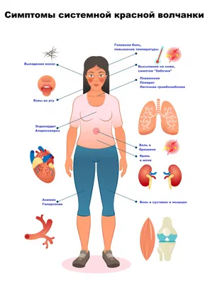 Системная красная волчанка - причины появления, симптомы заболевания,  диагностика и способы лечения