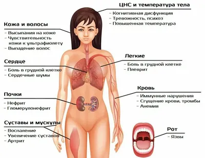 Системная красная волчанка или рассеянный склероз: а что тут можно вообще  перепутать? | А у меня тоже рассеянный склероз | Дзен