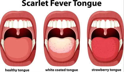 Скарлатина у детей: информация для родителей, симптомы, лечение,  инкубационный период