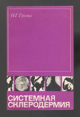 Системная склеродермия - что это за болезнь и когда заподозрить? | Григорий  Нефедов | Дзен