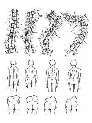 Сколиоз: симптомы, причины, диагностика и лечение