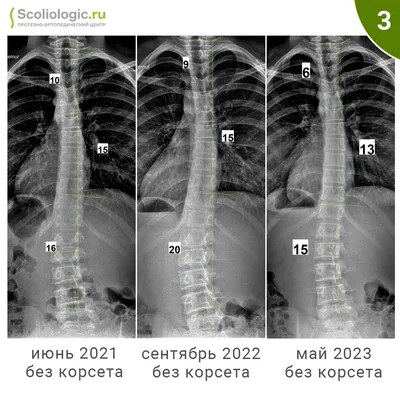 Степени сколиоза. Симптомы и диагностика сколиоза на разных стадиях