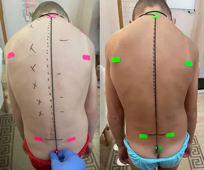 Сколиоз позвоночника 1,2,3,4 степени - лечение, симптомы, причины