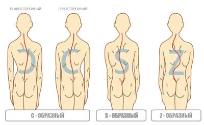 Берут ли в армию со сколиозом • ПризываНет