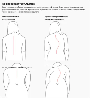 Степени сколиоза и их лечение в Москве | Отделение детской костной  патологии и ортопедии ЦИТО