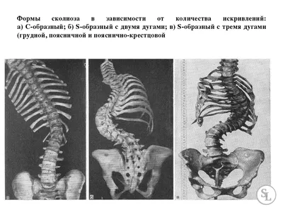 Сколиоз - фото пациентов