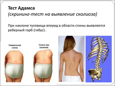 Сколиоз у подростка: что это, признаки, симптомы, диагностика и лечение