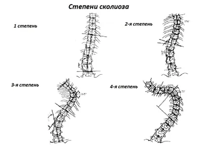 S-Образный сколиоз 1-2-3 степени, причины, лечение грудо-поясничного отдела  позвоночника