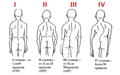 Берут ли в армию со сколиозом в 2024 году?