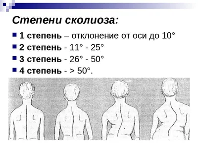 Лечение сколиоза позвоночника у взрослых в Москве, цены на хирургическое  лечение (операции) в клинике им. ак. Н.Н. Бурденко