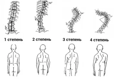 Сколиоз позвоночника 1,2,3,4 степени - лечение, симптомы, причины