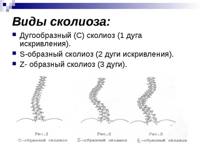 Лечение сколиоза (искривление позвоночника), лечить сколиоз в Киеве | Центр  кинезитерапии ЗДОРОВИЙ РУХ