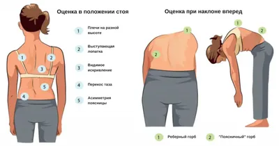 Как избежать сколиоза | ГБУЗ \"ЧОЦОЗ МП\"