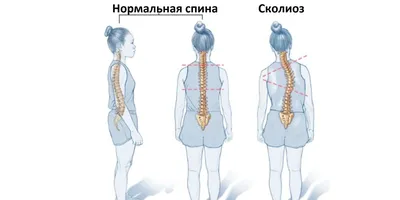 Сколиоз - лечение, симптомы, диагностика, причины, коррекция спины