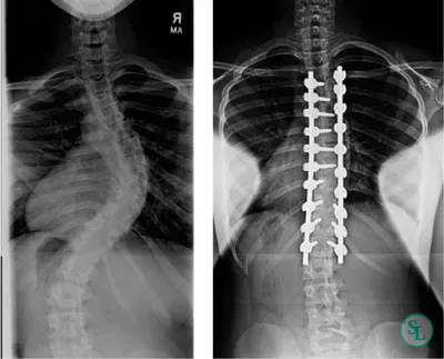 Массаж Минск Владимир Леончик - ❗Сколиоз 4 степени❗ 😱 ⠀ 🔹На фото S  образный сколиоз 4 степени. Самый часто встречающийся вариант сколиоза.  S-образный, комбинированный сколиоз (2 дуги) правосторонний грудной и  левосторонний поясничный.