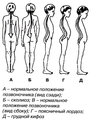 Корсет Шено 3D. Лечение сколиоза 2 и 3 степени