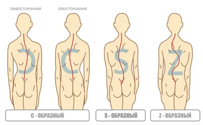 Лечение сколиоза позвоночника - Неврологический центр в Казани – клиника  «Хорошие Руки»