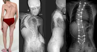 Сколиоз: виды, причины, лечение - KinesioPro