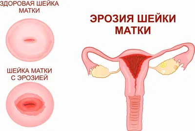 ГИПОМЕНОРЕЯ. Или скудные менструации ⠀ Я продолжаю с вами цикл постов по  нарушениям цикла. Были посты и про редкие и частые… | Instagram