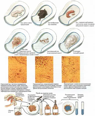 Сеть медицинских центров ОРИС - ПРИМЕСИ В КАЛЕ: ВИДЫ, ПРИЧИНЫ ПОЯВЛЕНИЯ И  МЕТОДЫ ЛЕЧЕНИЯ Большинству людей не свойственно внимательно осматривать  собственные фекалии, да и конструкция современной сантехники часто мешает  подобным исследованиям. Если