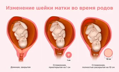 Слизистая пробка: как выглядит и что значит ее отхождение