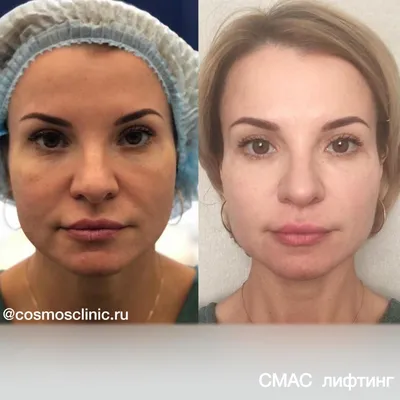 NKDERM | Фото до-после процедуры смас-лифтинга