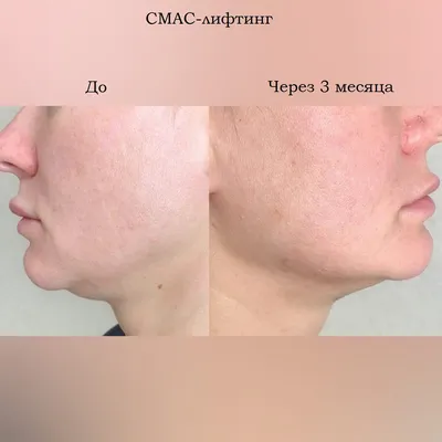 Фото До и После - Ageclinic