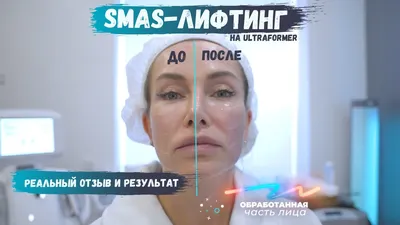 Смас лифтинг - цена выгодная на smas лифтинг в Киеве и Украине, заказать  процедуру смас лифтинг в косметологической клинике Medlas