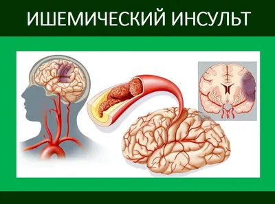 Инсульт-это смерть. Часть 3 (Смерть) | Яя БезысхоДнище | Дзен