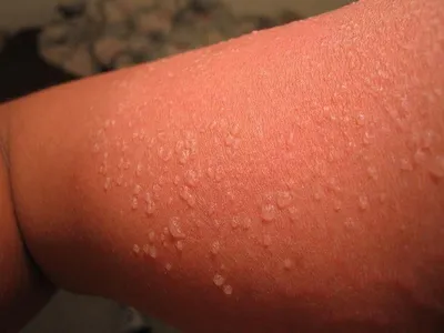 Солнечный дерматит фото