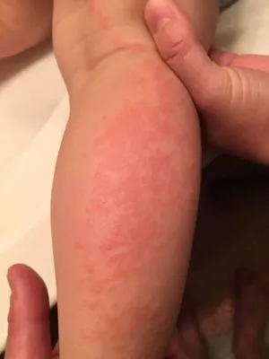 Лишай отрубевидный (Pityriasis versicolor, tinea versicolor) реферат по  медицине | Сочинения Медицина | Docsity