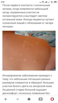 Опоясывающий лишай (опоясывающий герпес, herpes zoster): симптомы и  профилактика