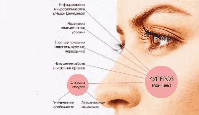 Сосудистые звездочки после 40 ? причины появления и методы борьбы - блог  Cleo Line