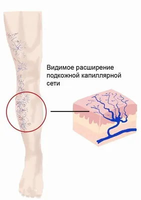 Лечение сосудистых звёздочек лазером в клинике