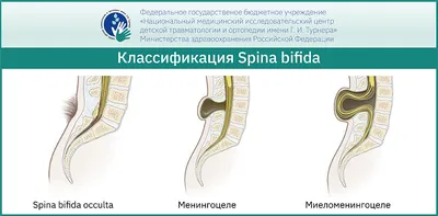 Spina bifida у детей – лечение патологии и особенности заболевания