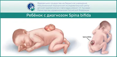 Лечение Spina bifida в России – эффективные методы лечения в НМИЦ им. Г. И.  Турнера