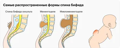 Благотворительный фонд «Спина бифида»