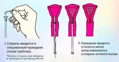 Удаление ВМС - удалить внутриматочную спираль в Одессе