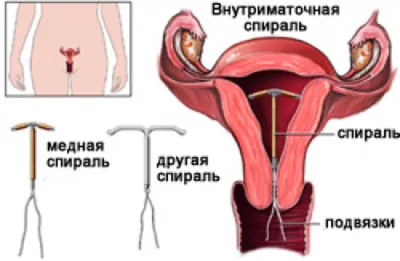 Гормональные спирали. | Врач гинеколог Оксана Алимова | Дзен