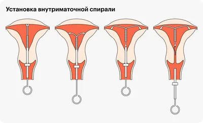 Фехралевая спираль купить в России от производителя нагревателей Технонагрев