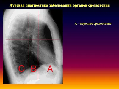 Рентгеновская диагностика заболеваний верхнего средостения | Второе мнение