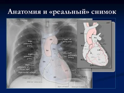 Опухоли средостения - презентация онлайн | Презентация, Лимфома ходжкина,  Синдром кушинга