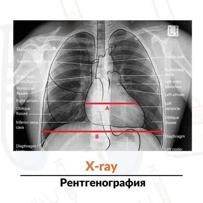 Средостение фото