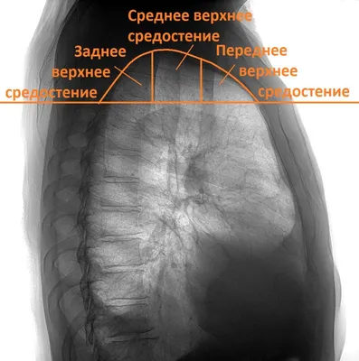 Опухоли средостения - симптомы, причины, диагностика, лечение