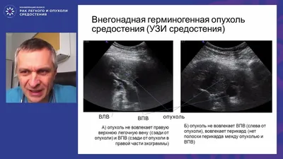 5.7. Видеоторакоскопии с биопсией лимфоузлов и образований средостения