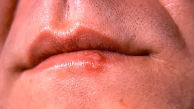 Противовирусное средство Девирс Крем для наружного применения - «Помощь в  устранении герпеса на губах +фото процесса развития болячки» | отзывы