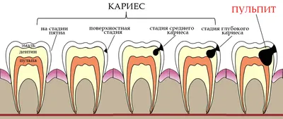 Средний кариес — симптомы, диагностика, лечение