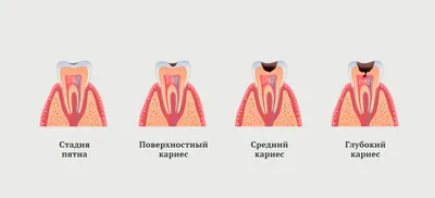 Какие виды и стадии кариеса зубов бывают, основные признаки и симптомы