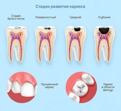 Лечение начальной стадии кариеса в СПб - Стоматологическая клиника \"Галерея  Улыбок\"