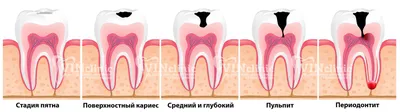 Лечение кариеса зубов, цена в Московской клинике